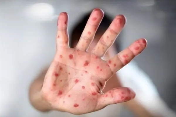 شناسایی ۶۷۳ مبتلا به سرخک در سال 1403