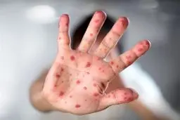 شناسایی ۶۷۳ مبتلا به سرخک در سال 1403