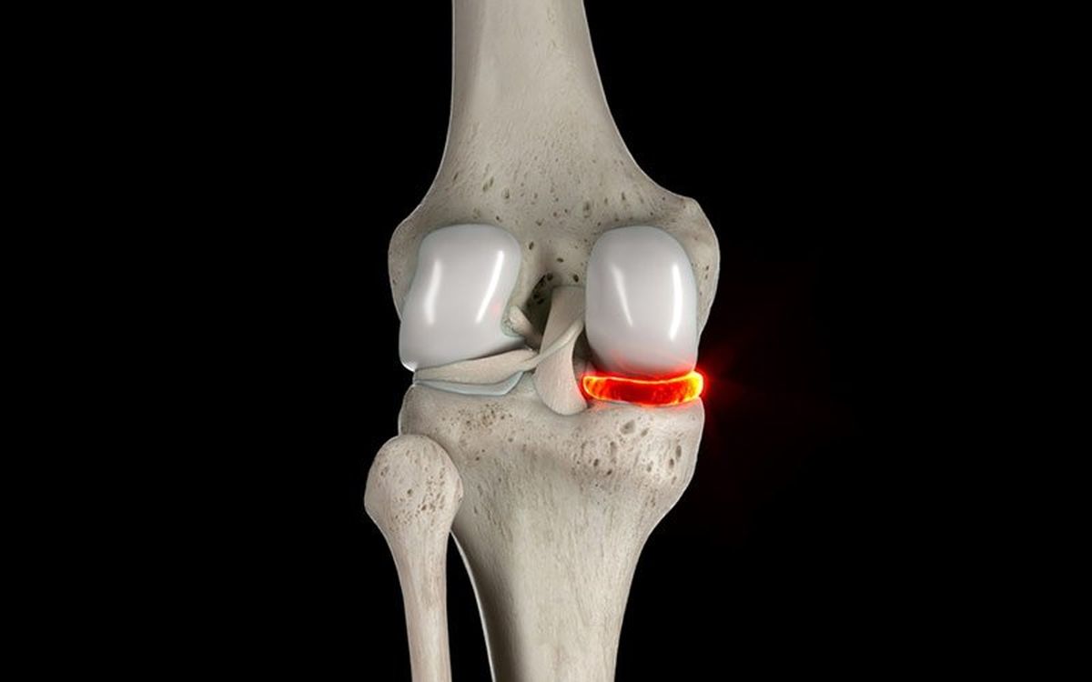 انواع درمان پارگی مینیسک زانو؛ راحت ترین و کم هزینه ترین روش