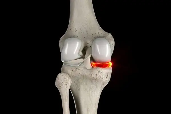 انواع درمان پارگی مینیسک زانو؛ راحت ترین و کم هزینه ترین روش