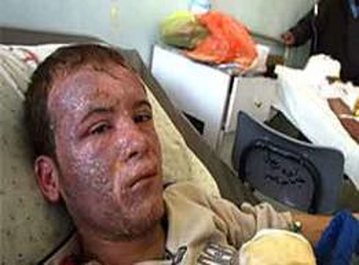 چهارشنبه سوری تاکنون ۱۳ مصدوم را روانه بیمارستان کرد/ عمده جراحات سوختگی دست و صورت است