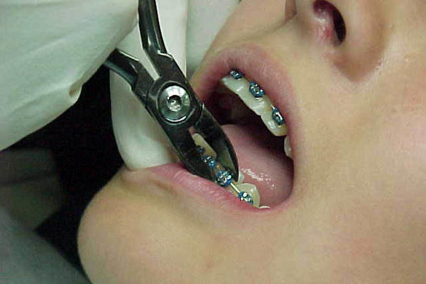 شاخص سلامت دندان در ایران بهبود نیافته؛ هر نوجوان ۴ دندان خراب دارد