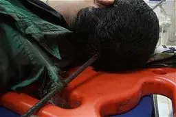 فرو رفتن میلگرد در جمجمه یک کارگر ۲۴ ساله