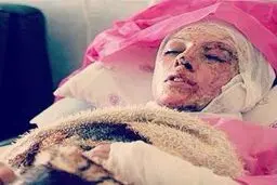 جزئیات جدید از حادثه اسیدپاشی در شمال غرب تهران