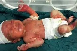 اعلام نظریه کمیسیون پزشکی در ارتباط با سوختگی نوزاد سه روزه صومعه‌سرایی