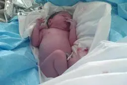 شکستگی بازوی نوزاد اصفهانی در حین عمل زایمان صحت نداشت