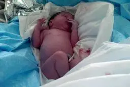 شکستگی بازوی نوزاد اصفهانی در حین عمل زایمان صحت نداشت