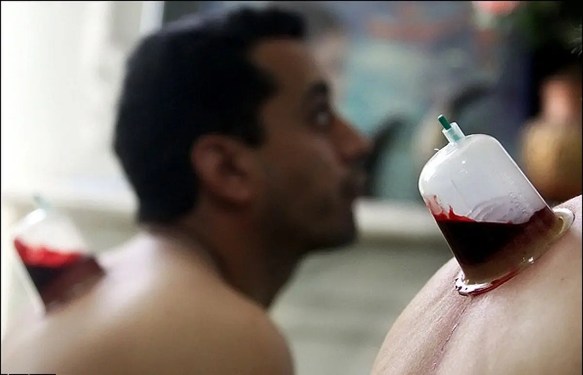 انتقال هپاتیت با "حجامت" و "خالکوبی" در کشور