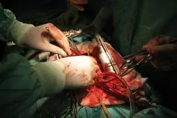 نگرانی از عوارض جراحی قلب بی‌مورد است