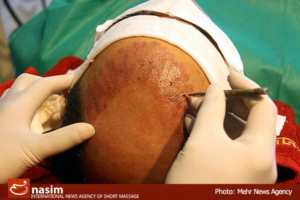 کچل‌ها طعمه دکتر قلابی کاشت مو/ تعطیلی مطب غیرمجاز در تهرانپارس+تصاویر
