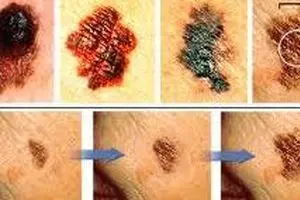 سرطان پوست شایع‌ترین سرطان در مردان ایرانی