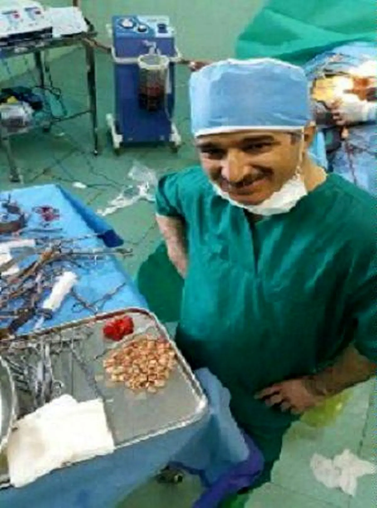 ۲۶۷ سنگ از مثانه یک بیمار در مشهد خارج شد + عکس