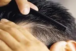 روش‌های طب سنتی در درمان سفیدی و ریزش مو