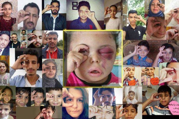 همدردی جهانی با کودک جنگ‌زده یمنی