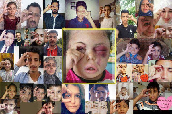 همدردی جهانی با کودک جنگ‌زده یمنی