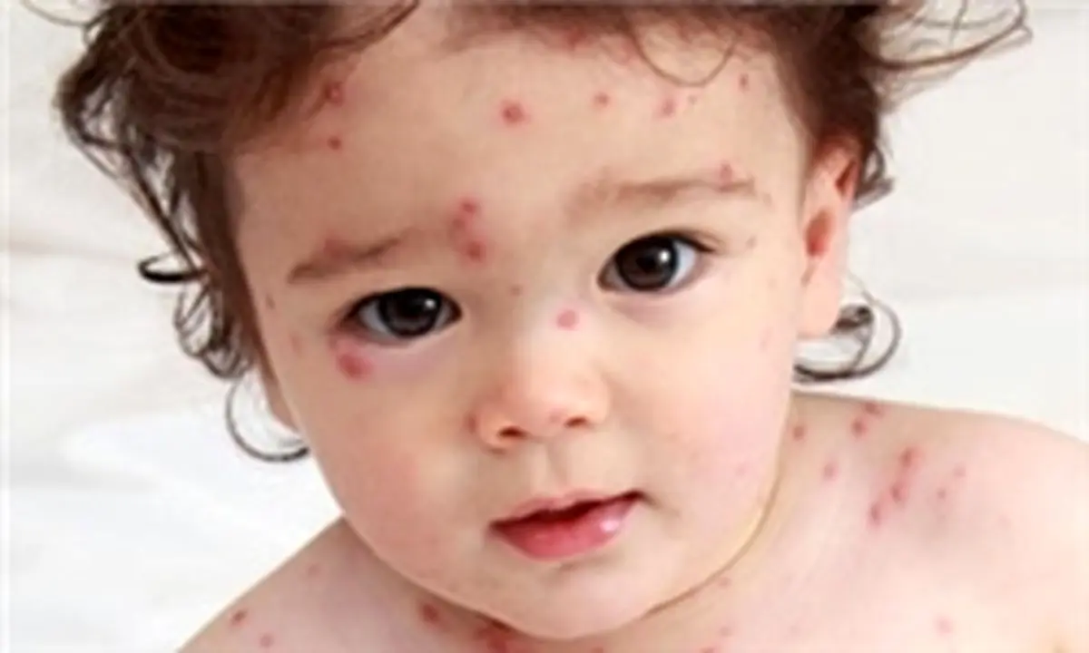 سرخک و سرخچه شدیداً ویروسی و واگیردار هستند/ سرخک ریشه‌کن شده‌است اما سرخچه به ندرت دیده‌می‌شود