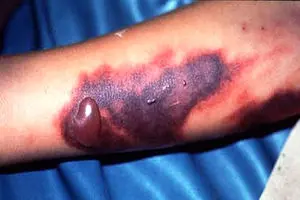 پای تب کنگو به پایتخت باز شد