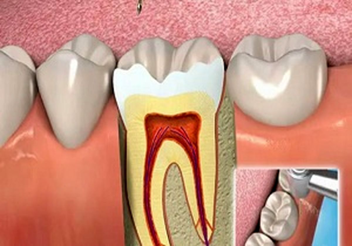 چرا دندان عصب کشی شده بازهم درد می‌گیرد؟