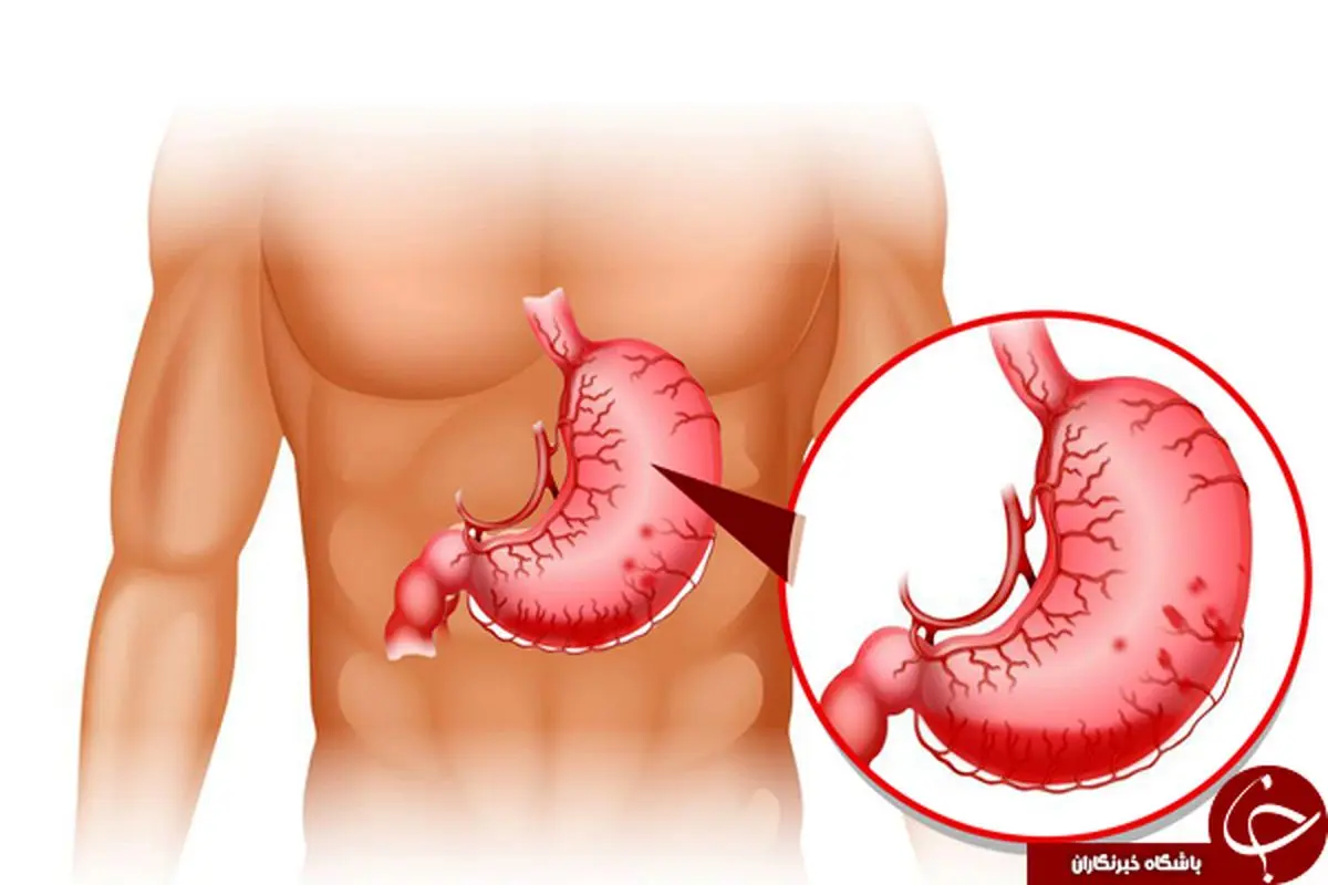 رایج‌ترین علائم زخم معده چیست و چه زمانی باید به پزشک مراجعه کرد؟