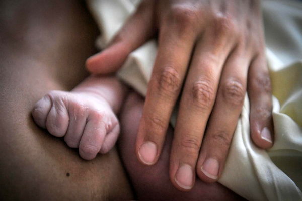 تولد نوزادان بدون دست فرانسه را نگران کرده است