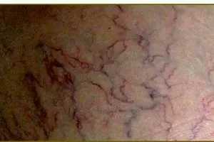 درمان رگ های عنکبوتی با نمک!