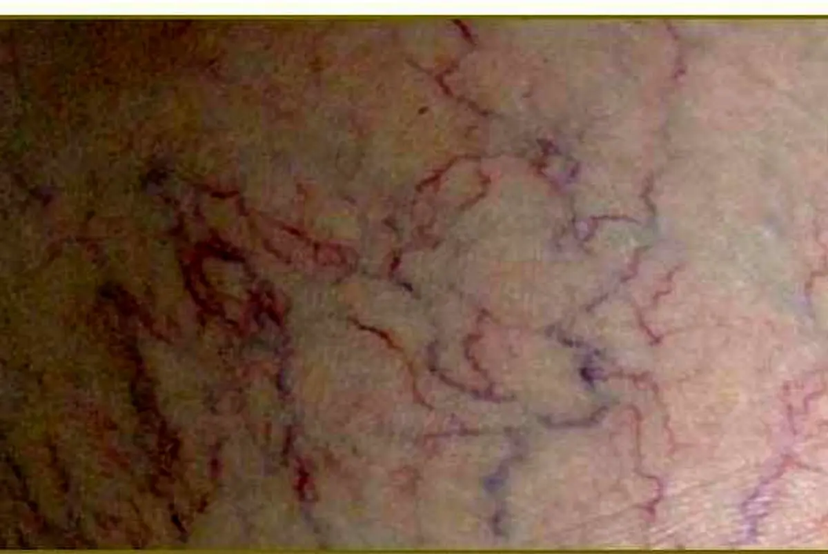 درمان رگ های عنکبوتی با نمک!