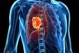 تشخیص بیماری با تی‌شرت «هوشمند»