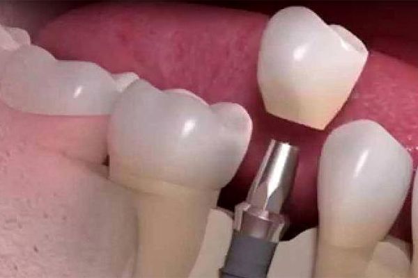 عمر مفید ایمپلنت های دندانی ۱۰ سال است