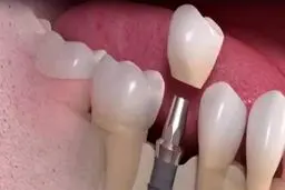 عمر مفید ایمپلنت های دندانی ۱۰ سال است