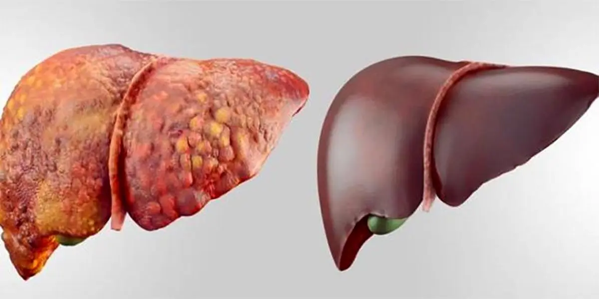 «کبد چرب» خود را به راحتی آب خوردن درمان کنید!