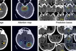 هوش مصنوعی خونریزی مغزی را تشخیص می‌دهد