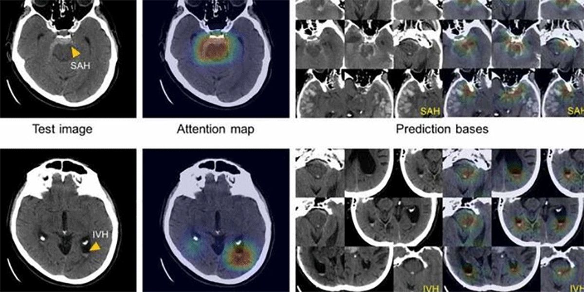 هوش مصنوعی خونریزی مغزی را تشخیص می‌دهد