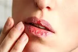 رفع ترک لب با طب سنتی