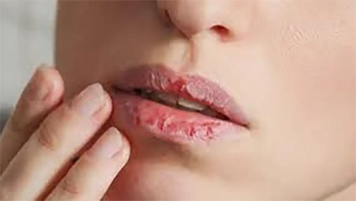 رفع ترک لب با طب سنتی