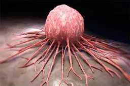 ششمین سرطان شایع جهان بیشتر چه افرادی را مبتلا می‌‌کند؟