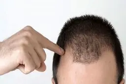 خوراکی‌های ضد ریزش مو