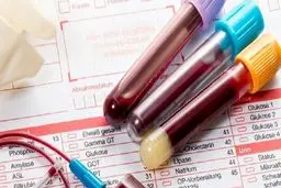 با این آزمایش ساده ۵۰ نوع سرطان شناسایی می‌شود