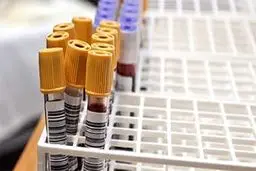 نمونه گیری چقدر در نتیجه تست کرونا موثر است؟