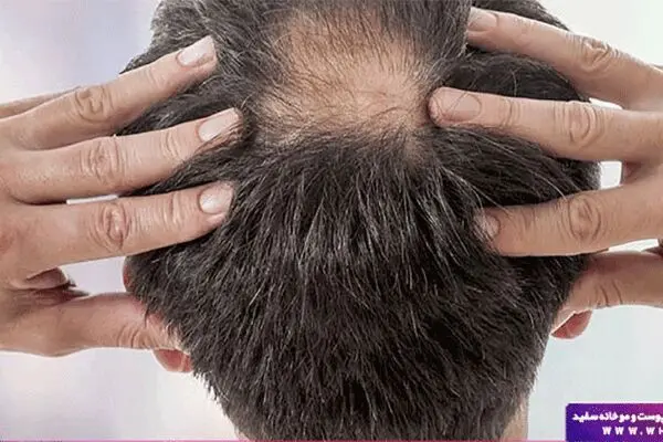 آنچه باید در مورد کاشت مو و کاشت ابرو بدانید !