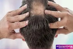 آنچه باید در مورد کاشت مو و کاشت ابرو بدانید !