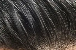 کاشت مو و جراحی لیپوساکشن با کلینیک نوین ایرانا