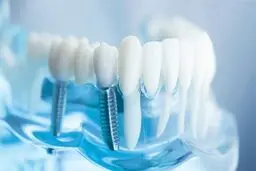 جراحی ایمپلنت چیست و چطور برای آن آماده شویم؟