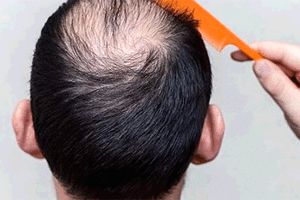 5 راه درمان ریزش مو