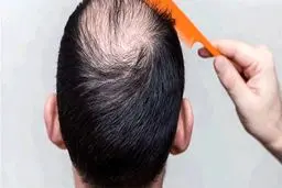 5 راه درمان ریزش مو