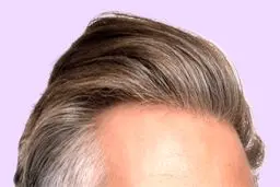 همه چیز درباره کاشت مو به روش sut