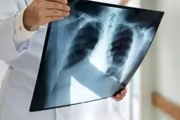  ترمیم بافت ریه بیماران کرونایی تا ۳ ماه زمان می‌برد 