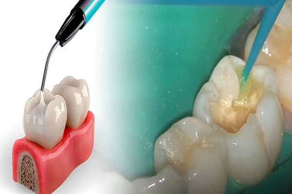 ابزار و مواد پر کاربرد در ترمیم کامپوزیت دندان