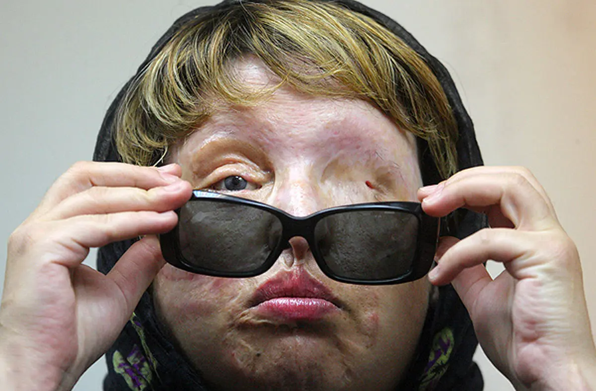 فیلم:: اظهارنظر قربانیان اسیدپاشی درباره جزئیات این واقعه