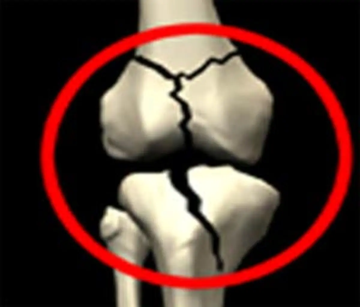 گزارش «نسیم» از تحلیل‌های کارشناسان و متخصصان از پوکی استخوان در فارس