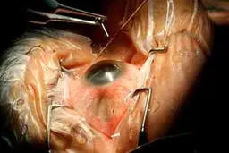 رئیس گروه گلوکوم کنگره چشم‌‌پزشکی از عرضه داروهای جدید گلوکم در آینده‌‌ نزدیک خبر داد